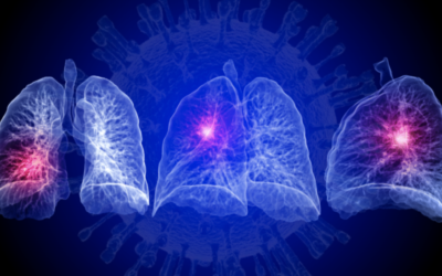 CuraCloud Enhances CT Triage Capabilities to Include Pneumonia Associated with COVID-19