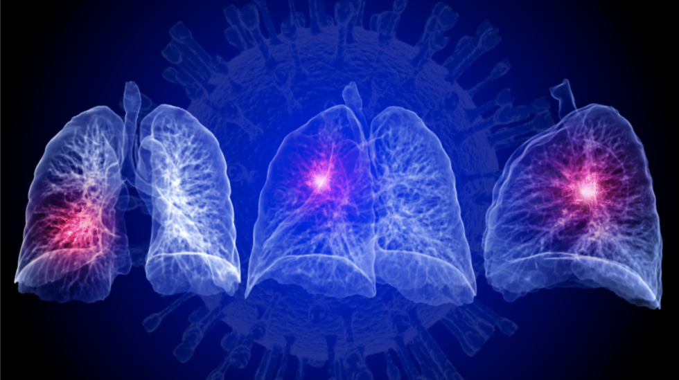 CuraCloud Enhances CT Triage Capabilities to Include Pneumonia Associated with COVID-19