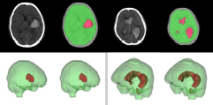 Deep learning for Intracranial Hemorrhage Classification and Segmentation