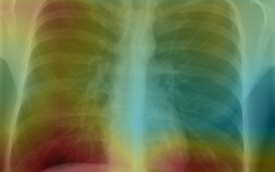 The Big Data Boom in Chest Radiography