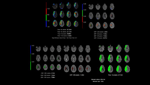 DeepVessel Stroke