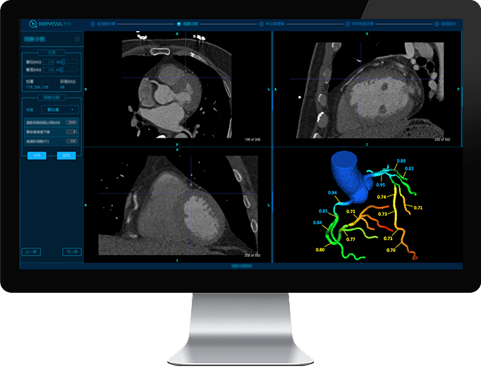 DEEPVESSEL-FFR DeepVessel FFR software displayed on desktop