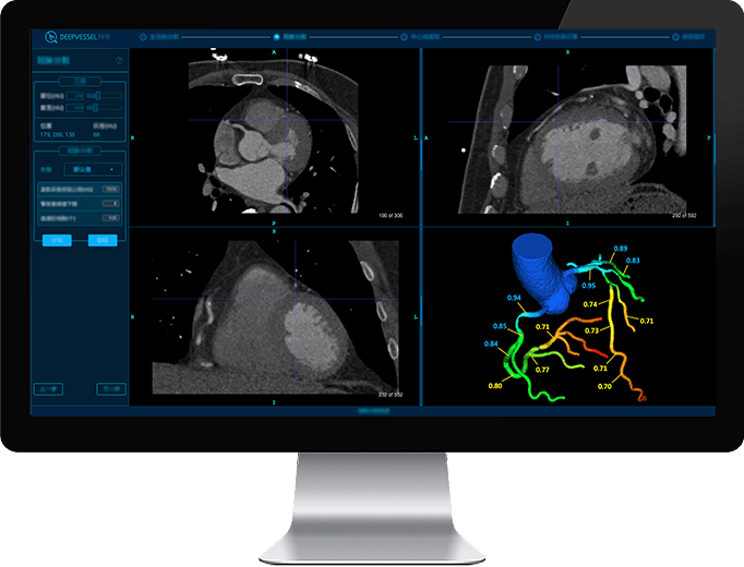 DeepVessel FFR software displayed on desktop