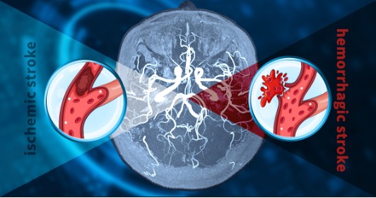 Ischemic versus Hemorrhagic Strokes