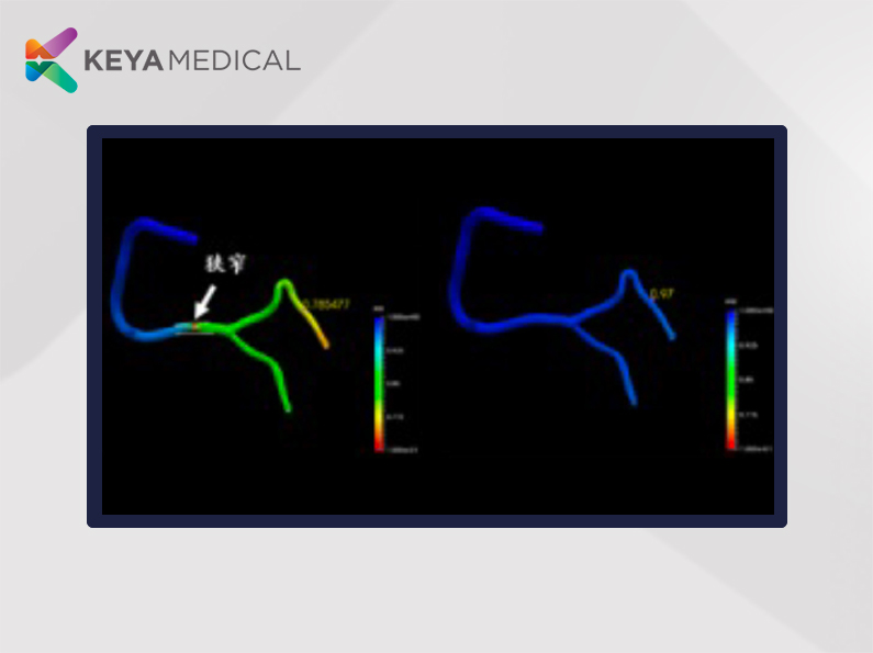 DeepVessel SmartPCI