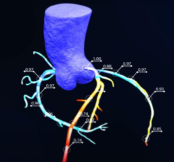 DEEPVESSEL FFR CT-Recent Peer-Reviewed Publications